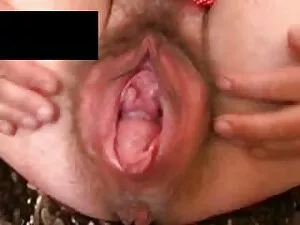 Couloir anal en les  ...